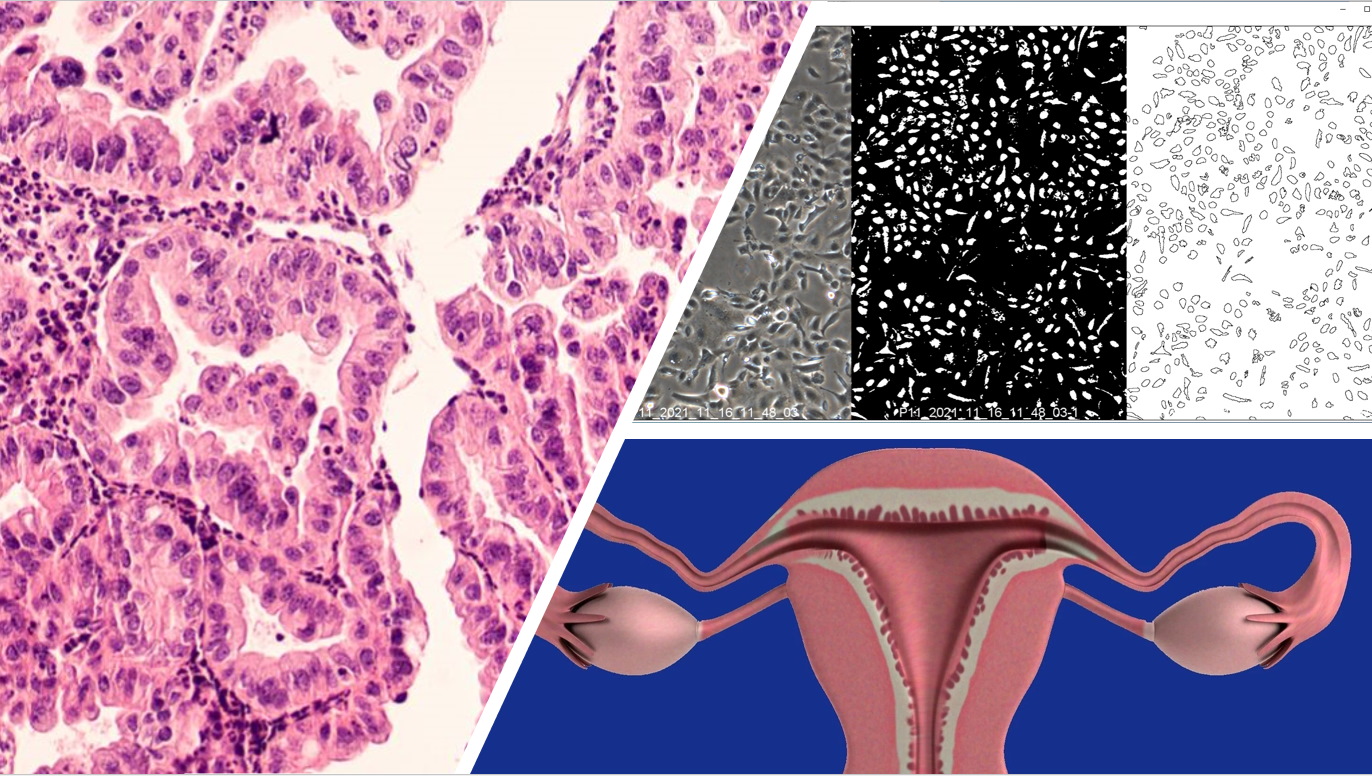 Recreating in vitro conditions similar to those in the body of a patient with ovarian cancer